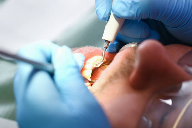 Best Emergency Treatment for Dental Infections or Abscesses in Clarkston, WA
